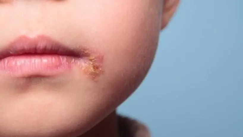Herpes simple
